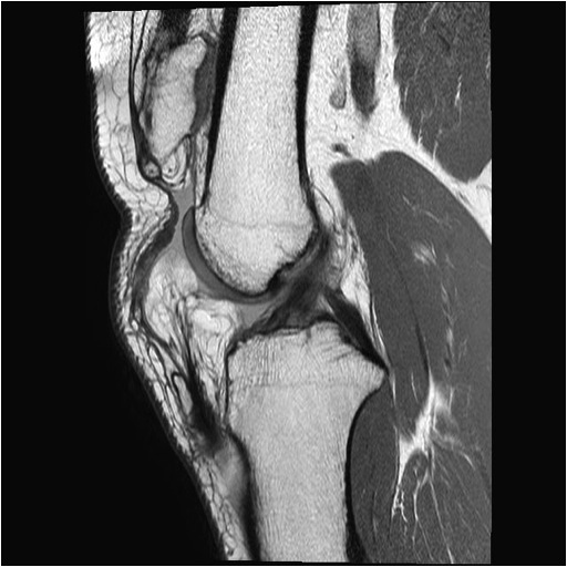 Chronic Patella Tendon Rupture MRI